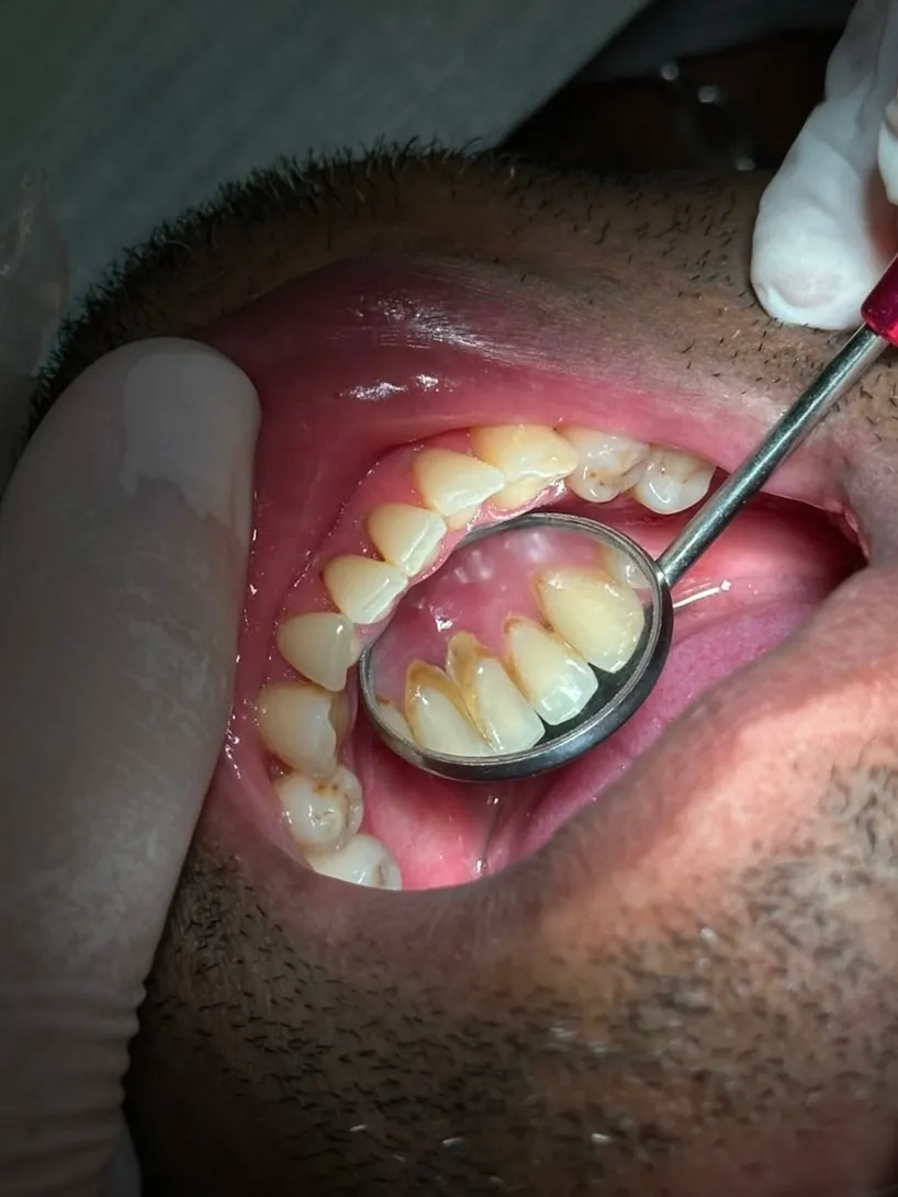 Antes do tratamento: Limpeza e manutenção Periodontal