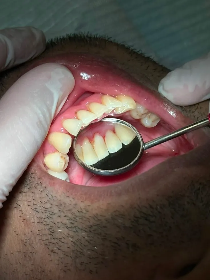 Depois do tratamento: Limpeza e manutenção Periodontal