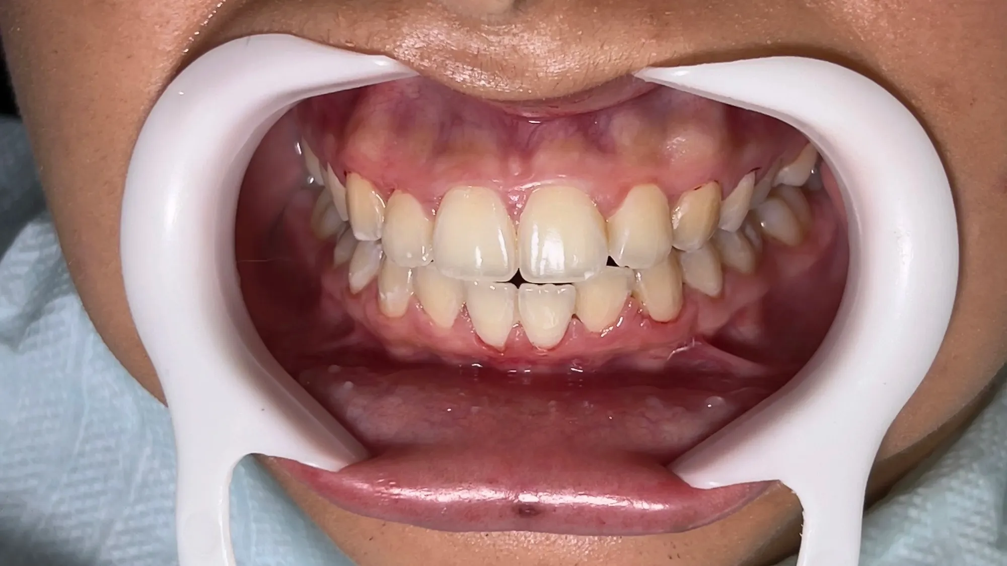 Depois do tratamento: Clareamento dental de consultório.